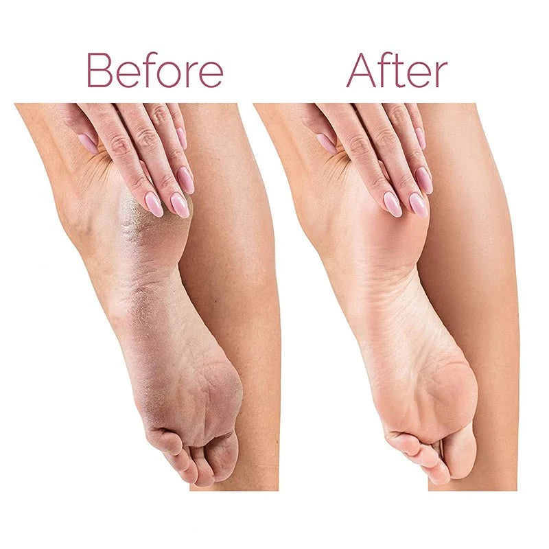 Rechargeable Electric Callus Remover – Foot Care Tool |Habi Mart